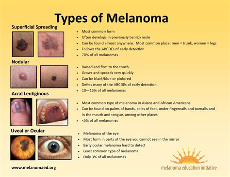 melanoma skin cancer types